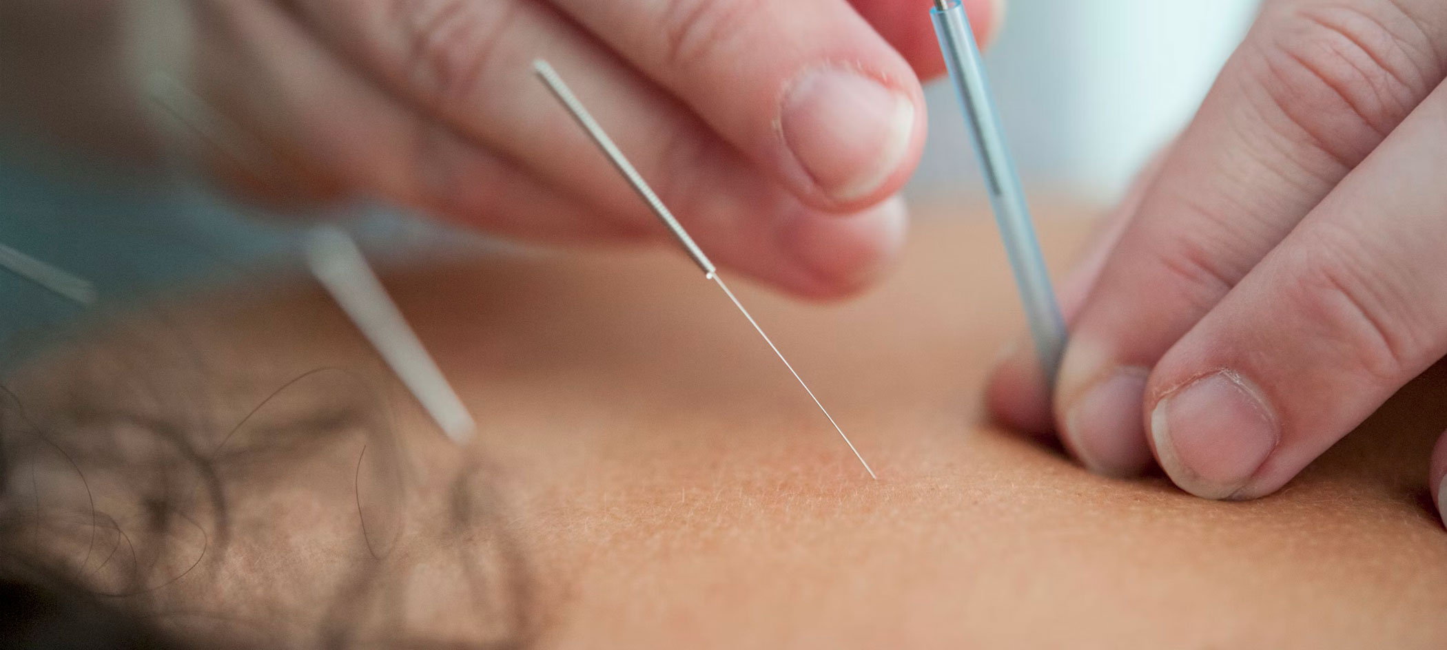 acupuncture